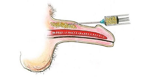 Inject hyaluronic acid into the member's barrel to increase its